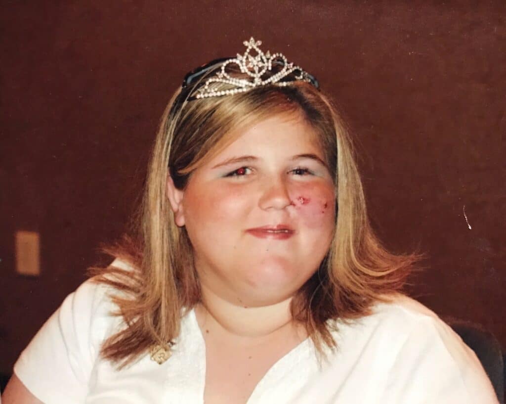 Smiling girl with a tiara and visible facial bruises, wearing a white shirt, in front of a brown background.